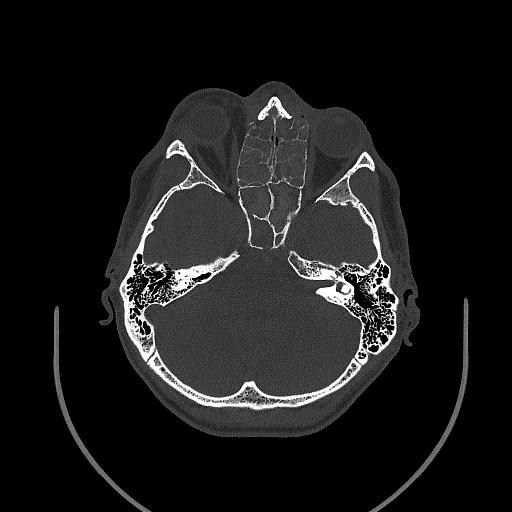 Chronic invasive fungal sinusitis (Radiopaedia 50342-55710 Axial bone window 77).jpg