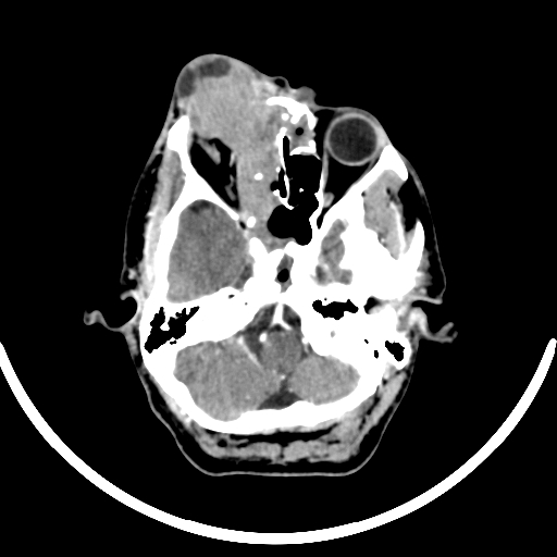 Chronic invasive fungal sinusitis with intraorbital and intracranial extension (Radiopaedia 56387-63046 B 95).jpg
