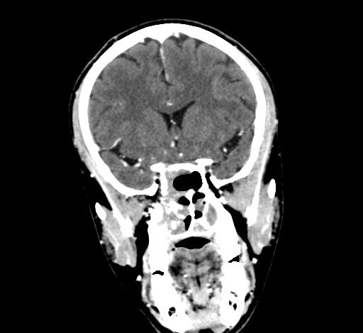 Chronic invasive fungal sinusitis with intraorbital and intracranial extension (Radiopaedia 56387-63046 C 152).jpg