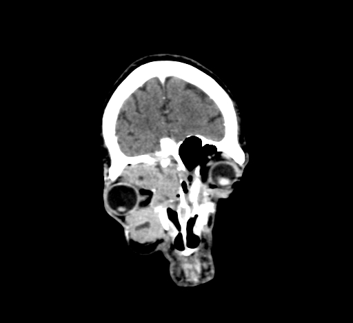 Chronic invasive fungal sinusitis with intraorbital and intracranial extension (Radiopaedia 56387-63046 C 64).jpg