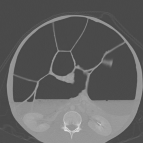Chronic large bowel pseudo-obstruction (Radiopaedia 43181-46492 Axial bone window 90).jpg