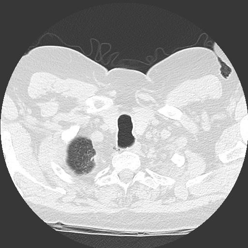 File:Chronic lung allograft dysfunction - restrictive form (Radiopaedia 60595-68316 Axial lung window 4).jpg
