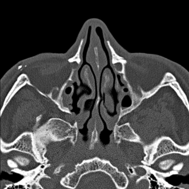 Chronic maxillary sinusitis (Radiopaedia 27879-28116 Axial bone window 23).jpg