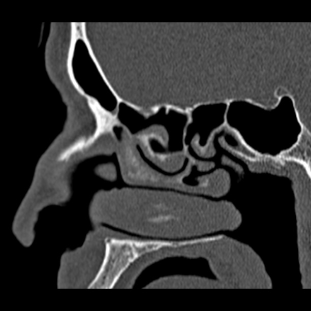 Chronic maxillary sinusitis (Radiopaedia 27879-28116 Sagittal bone window 23).jpg