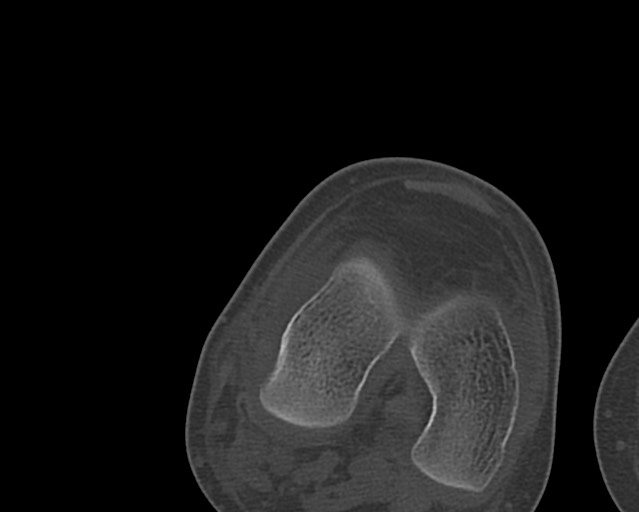 File:Chronic ostemyelitis of the femur with long sinus tract (Radiopaedia 74947-85982 Axial bone window 224).jpg