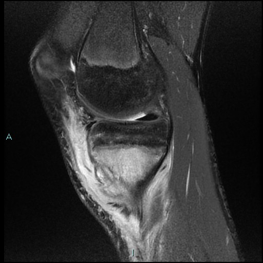 File:Chronic osteomyelitis (with Brodie abscess) (Radiopaedia 76405-88112 Sagittal PD fat sat 8).jpg