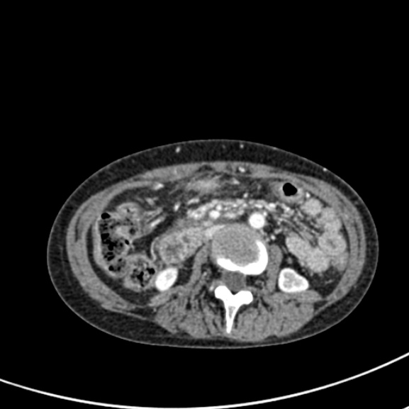 Chronic pancreatitis (Radiopaedia 55405-61846 A 50).jpg