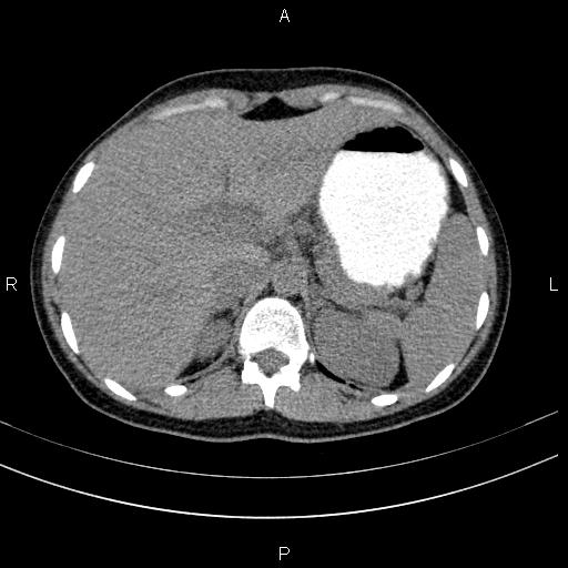 File:Chronic pancreatitis (Radiopaedia 64576-73450 Axial non-contrast 29).jpg