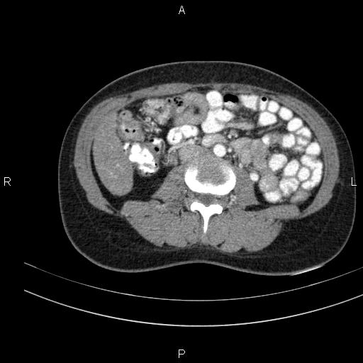 Chronic pancreatitis (Radiopaedia 64576-73450 B 87).jpg