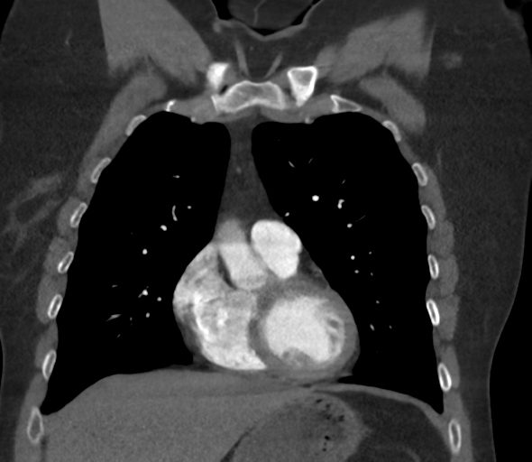 Chronic pulmonary embolus (Radiopaedia 39129-41341 Coronal C+ CTPA 31).png