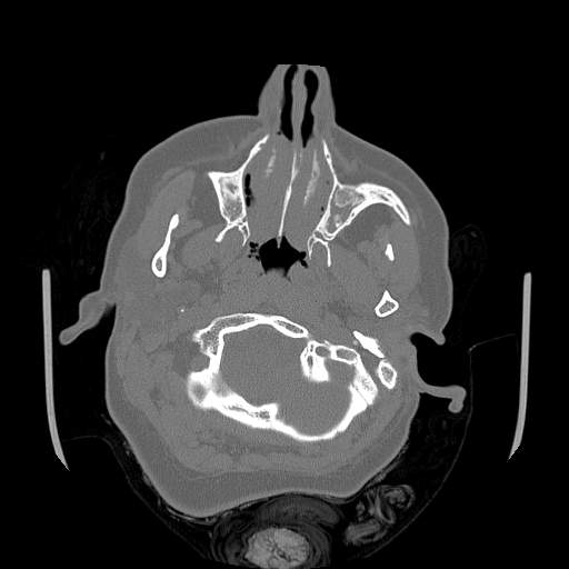 Chronic sinusitis with intra-sinus calcification (Radiopaedia 63919-72668 Axial bone window 67).jpg