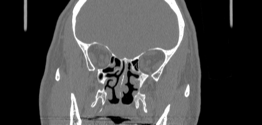 Chronic sphenoidal sinusitis (Radiopaedia 62030-70122 Coronal bone window 84).jpg