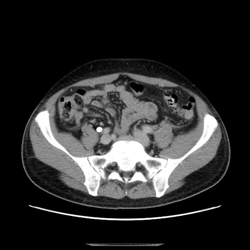 File:Chronic ureteropelvic junction obstruction (Radiopaedia 78365-90996 A 93).jpg