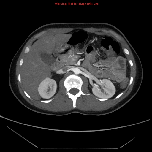 File:Circumaortic left renal vein (Radiopaedia 9069-9792 A 15).jpg