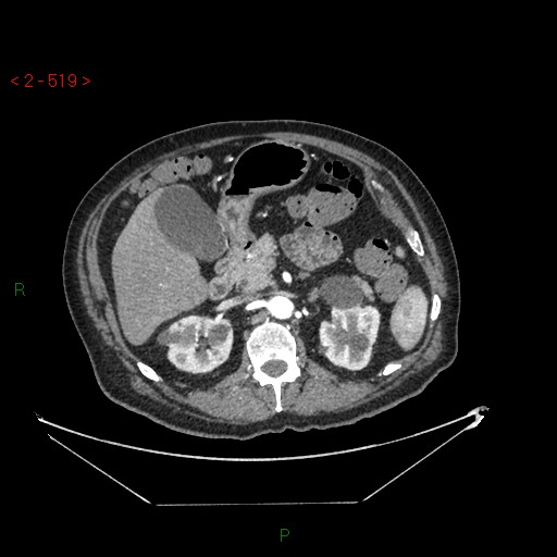 Circumaortic left renal vein and doubled left renal arteries (Radiopaedia 52268-58158 A 55).jpg