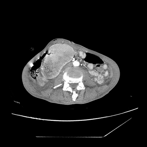 Closed-loop obstruction due to peritoneal seeding mimicking internal hernia after total gastrectomy (Radiopaedia 81897-95864 A 112).jpg