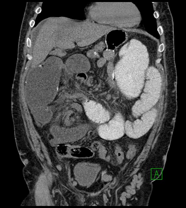 Closed-loop small bowel obstruction-internal hernia (Radiopaedia 78439-91096 Coronal non-contrast 38).jpg
