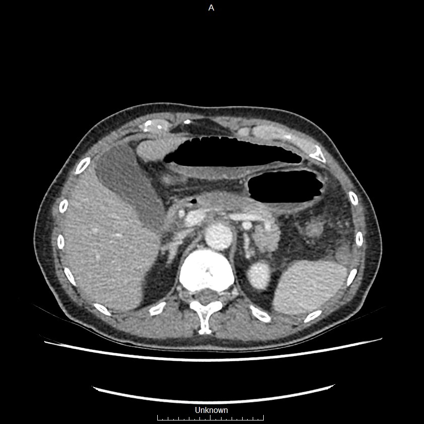 Closed loop bowel obstruction and ischemia (Radiopaedia 86959-103180 A 15).jpg