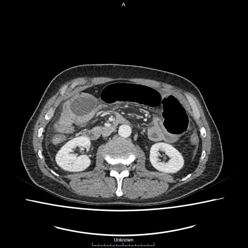 Closed loop bowel obstruction and ischemia (Radiopaedia 86959-103180 A 32).jpg