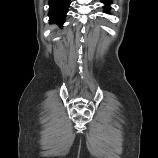 File:Closed loop obstruction due to adhesive band, resulting in small bowel ischemia and resection (Radiopaedia 83835-99023 C 110).jpg