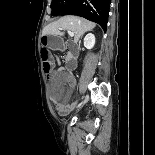 File:Closed loop obstruction due to adhesive band, resulting in small bowel ischemia and resection (Radiopaedia 83835-99023 F 75).jpg