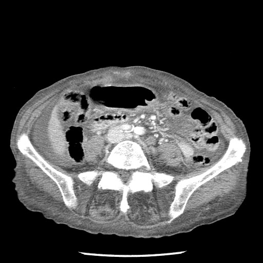 File:Closed loop small bowel obstruction - adhesions and infarct (Radiopaedia 85125-100678 B 59).jpg