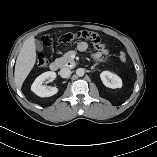 Closed loop small bowel obstruction - internal hernia (Radiopaedia 57806-64778 B 45).jpg