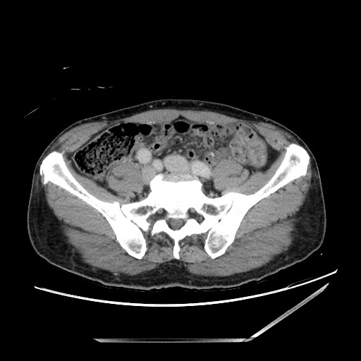 Closed loop small bowel obstruction - omental adhesion causing "internal hernia" (Radiopaedia 85129-100682 A 120).jpg