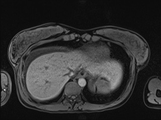 Closed loop small bowel obstruction in pregnancy (MRI) (Radiopaedia 87637-104031 Axial T1 fat sat 16).jpg