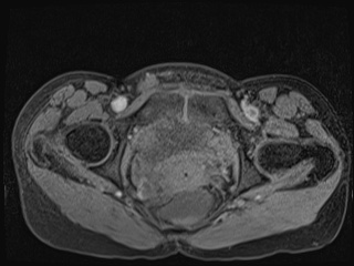 Closed loop small bowel obstruction in pregnancy (MRI) (Radiopaedia 87637-104031 F 69).jpg