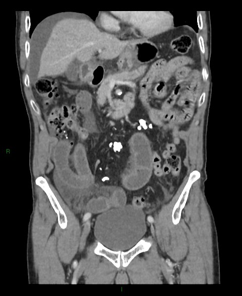 File:Closed loop small bowel obstruction with ischemia (Radiopaedia 84180-99456 B 40).jpg
