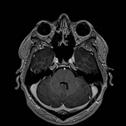 File:Cochlear incomplete partition type III associated with hypothalamic hamartoma (Radiopaedia 88756-105498 Axial T1 C+ 66).jpg