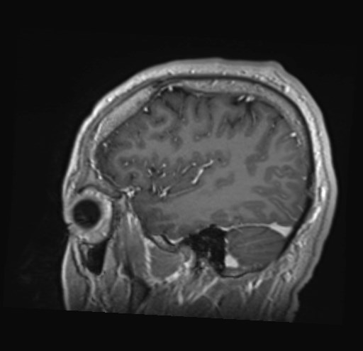 File:Cochlear incomplete partition type III associated with hypothalamic hamartoma (Radiopaedia 88756-105498 Sagittal T1 C+ 42).jpg