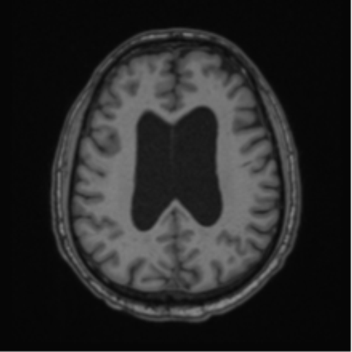 File:Colloid cyst of the third ventricle (Radiopaedia 86571-102662 Axial T1 52).png