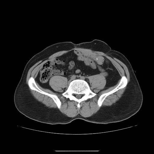 File:Colocutaneous fistula in Crohn's disease (Radiopaedia 29586-30093 Axial non-contrast 21).jpg