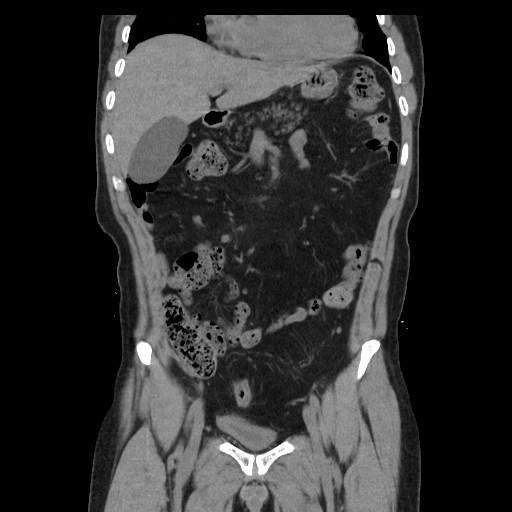 File:Colocutaneous fistula in Crohn's disease (Radiopaedia 29586-30093 Coronal non-contrast 6).jpg