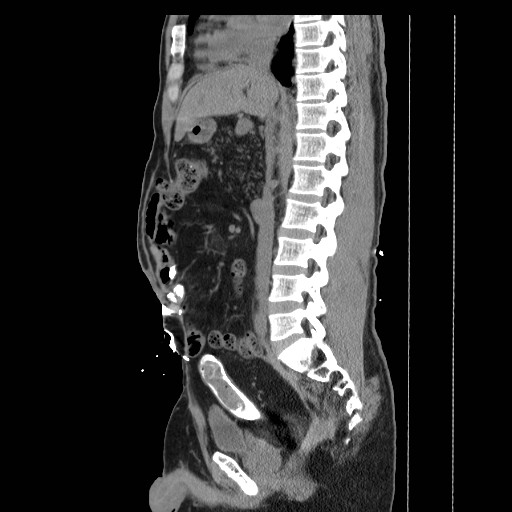 File:Colocutaneous fistula in Crohn's disease (Radiopaedia 29586-30093 F 12).jpg