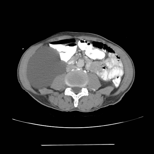 File:Colon cancer with calcified liver metastasis (Radiopaedia 74423-85307 A 40).jpg