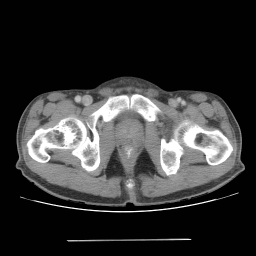File:Colon cancer with calcified liver metastasis (Radiopaedia 74423-85307 A 77).jpg
