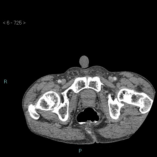 File:Colonic cancer (ultrasound and TC imaging) (Radiopaedia 50346-55713 A 149).jpg