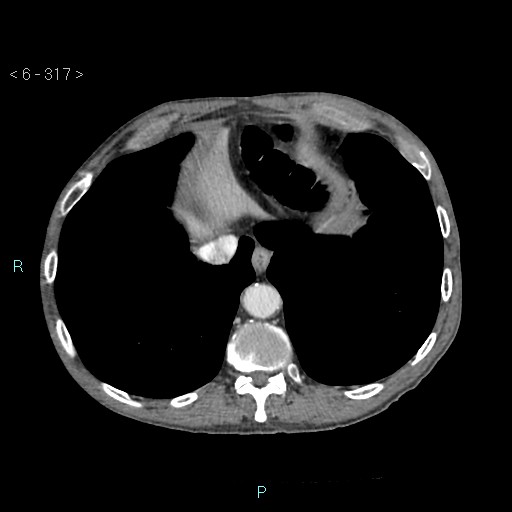 File:Colonic cancer (ultrasound and TC imaging) (Radiopaedia 50346-55713 B 317).jpg