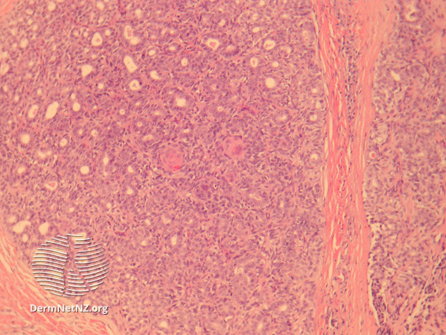 File:Figure 3 (DermNet NZ pathology-e-aggressive-adenocarcinoma-fig3).jpg
