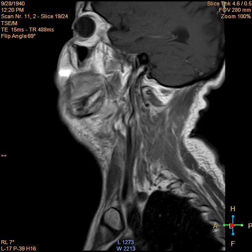 File:Nasopharyngeal carcinoma (Radiopaedia 22375-22403 Sagittal T1 C+ 13).jpg