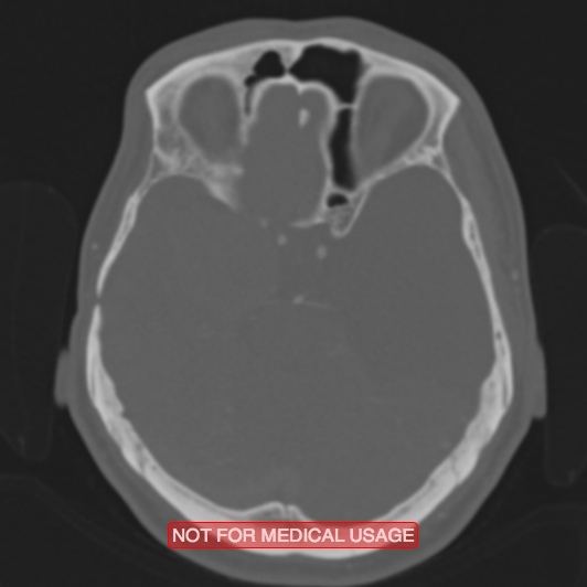 Nasopharyngeal carcinoma recurrence - skull base destruction (Radiopaedia 29107-29490 Axial bone window 68).jpg