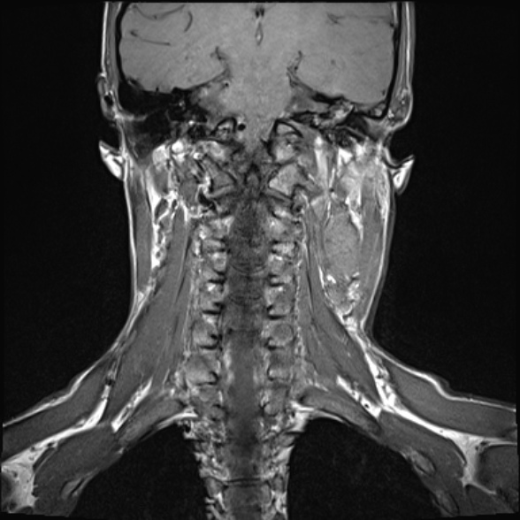 Nasopharyngeal carcinoma with skull base invasion (Radiopaedia 53415-59485 Coronal T1 11).jpg
