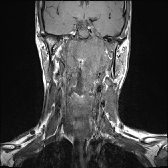 Nasopharyngeal carcinoma with skull base invasion (Radiopaedia 53415-59485 Coronal T1 18).jpg