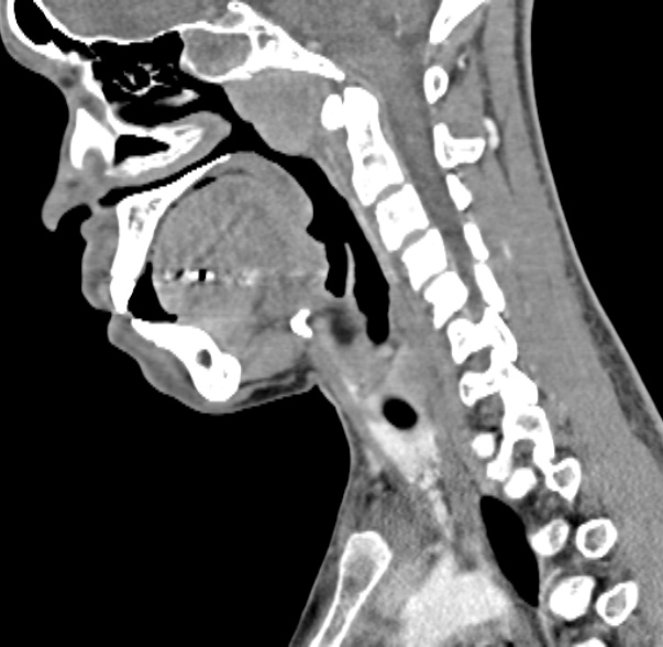 Nasopharyngeal carcinoma with skull base invasion (Radiopaedia 53415-59705 C 36).jpg