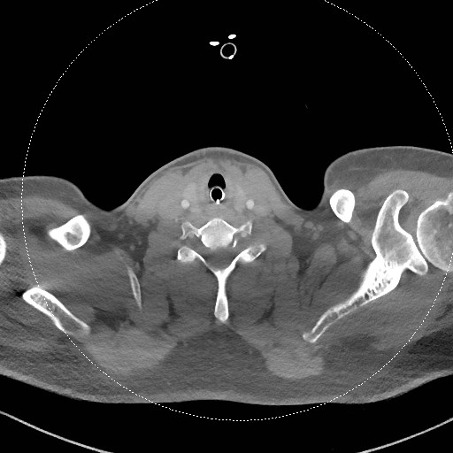 Neck CT angiogram (intraosseous vascular access) (Radiopaedia 55481-61945 B 140).jpg