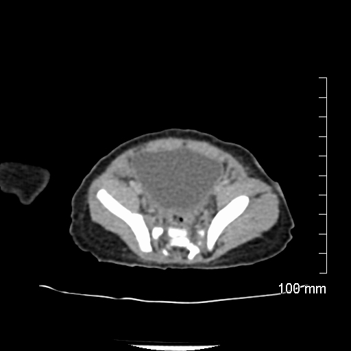 File:Neonatal neuroblastoma (Radiopaedia 56651-63438 Axial non-contrast 67).jpg