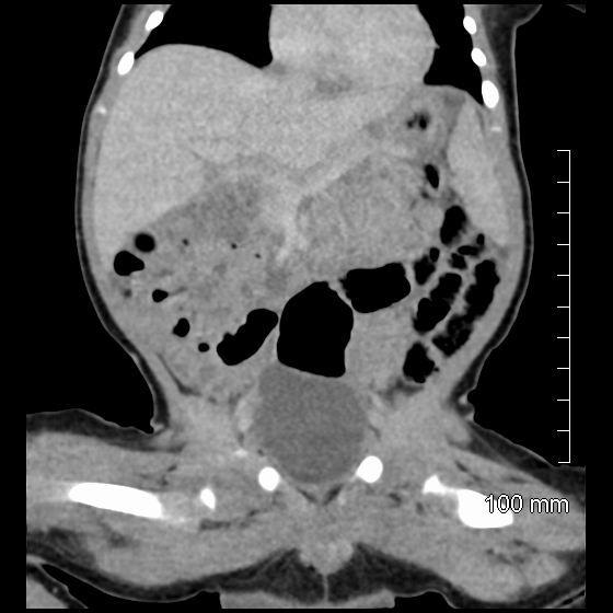 File:Neonatal neuroblastoma (Radiopaedia 56651-63438 Coronal non-contrast 24).jpg